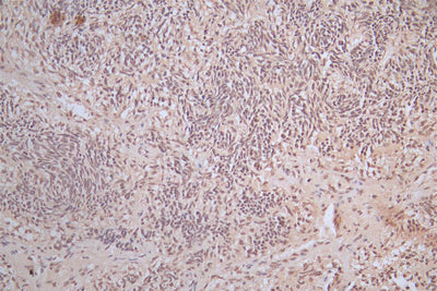 IHC image of SNCA Recombinant Monoclonal Antibody diluted at 1:100 and staining in paraffin-embedded human glioma cancer performed on a Leica BondTM system. After dewaxing and hydration, antigen retrieval was mediated by high pressure in a citrate buffer (pH 6.0). Section was blocked with 10% normal goat serum 30min at RT. Then primary antibody (1% BSA) was incubated at 4°C overnight. The primary is detected by a Goat anti-Mouse IgG labeled by HRP and visualized using 0.05% DAB.