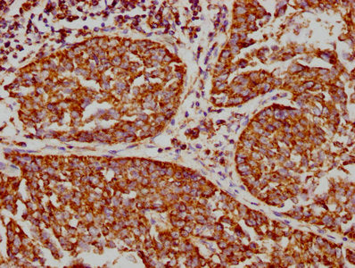 IHC image of VDAC1 Recombinant Monoclonal Antibody diluted at 1:73.125 and staining in paraffin-embedded human cervical cancer performed on a Leica BondTM system. After dewaxing and hydration, antigen retrieval was mediated by high pressure in a citrate buffer (pH 6.0). Section was blocked with 10% normal goat serum 30min at RT. Then primary antibody (1% BSA) was incubated at 4℃ overnight. The primary is detected by a biotinylated secondary antibody and visualized using an HRP conjugated SP system.