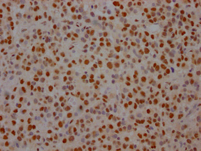IHC image of SF3B1 Recombinant Monoclonal Antibody diluted at 1:100 and staining in paraffin-embedded human glioma cancer performed on a Leica BondTM system. After dewaxing and hydration, antigen retrieval was mediated by high pressure in a citrate buffer (pH 6.0). Section was blocked with 10% normal goat serum 30min at RT. Then primary antibody (1% BSA) was incubated at 4℃ overnight. The primary is detected by a Goat anti-rabbit IgG polymer labeled by HRP and visualized using 0.05% DAB.