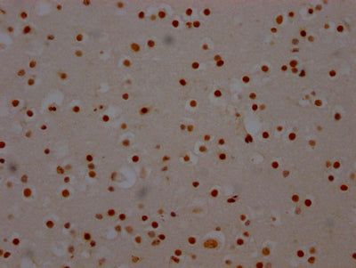 IHC image of SF3B1 Recombinant Monoclonal Antibody diluted at 1:100 and staining in paraffin-embedded human brain tissue performed on a Leica BondTM system. After dewaxing and hydration, antigen retrieval was mediated by high pressure in a citrate buffer (pH 6.0). Section was blocked with 10% normal goat serum 30min at RT. Then primary antibody (1% BSA) was incubated at 4℃ overnight. The primary is detected by a Goat anti-rabbit IgG polymer labeled by HRP and visualized using 0.05% DAB.
