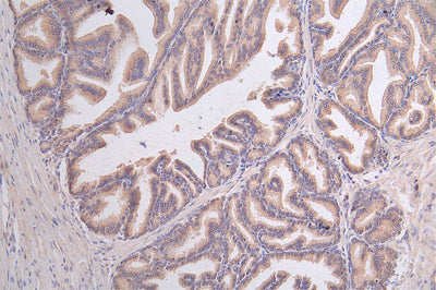 IHC image of GPI Recombinant Monoclonal Antibody diluted at 1:50 and staining in paraffin-embedded human prostate tissue performed on a Leica BondTM system. After dewaxing and hydration, antigen retrieval was mediated by high pressure in a citrate buffer (pH 6.0). Section was blocked with 10% normal goat serum 30min at RT. Then primary antibody (1% BSA) was incubated at 4°C overnight. The primary is detected by a Goat anti-rabbit polymer IgG labeled by HRP and visualized using 0.45% DAB.GPI Recombinant Monoclonal Antibody