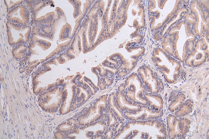 IHC image of GPI Recombinant Monoclonal Antibody diluted at 1:50 and staining in paraffin-embedded human prostate tissue performed on a Leica BondTM system. After dewaxing and hydration, antigen retrieval was mediated by high pressure in a citrate buffer (pH 6.0). Section was blocked with 10% normal goat serum 30min at RT. Then primary antibody (1% BSA) was incubated at 4°C overnight. The primary is detected by a Goat anti-rabbit polymer IgG labeled by HRP and visualized using 0.45% DAB.GPI Recombinant Monoclonal Antibody