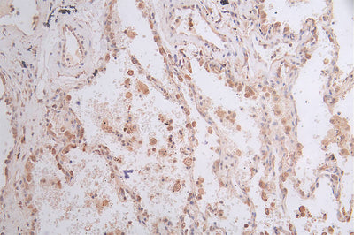 IHC image of GPI Recombinant Monoclonal Antibody diluted at 1:50 and staining in paraffin-embedded human lung cancer performed on a Leica BondTM system. After dewaxing and hydration, antigen retrieval was mediated by high pressure in a citrate buffer (pH 6.0). Section was blocked with 10% normal goat serum 30min at RT. Then primary antibody (1% BSA) was incubated at 4°C overnight. The primary is detected by a Goat anti-rabbit polymer IgG labeled by HRP and visualized using 0.45% DAB.GPI Recombinant Monoclonal Antibody