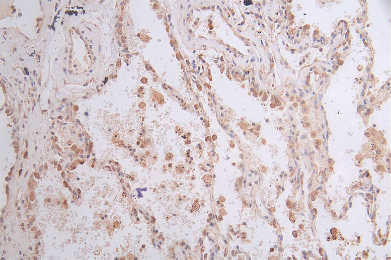 IHC image of GPI Recombinant Monoclonal Antibody diluted at 1:50 and staining in paraffin-embedded human lung cancer performed on a Leica BondTM system. After dewaxing and hydration, antigen retrieval was mediated by high pressure in a citrate buffer (pH 6.0). Section was blocked with 10% normal goat serum 30min at RT. Then primary antibody (1% BSA) was incubated at 4°C overnight. The primary is detected by a Goat anti-rabbit polymer IgG labeled by HRP and visualized using 0.45% DAB.GPI Recombinant Monoclonal Antibody