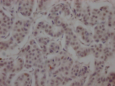 IHC image of BRD4 Recombinant Monoclonal Antibody diluted at 1:100 and staining in paraffin-embedded human breast cancer performed on a Leica BondTM system. After dewaxing and hydration, antigen retrieval was mediated by high pressure in a citrate buffer (pH 6.0). Section was blocked with 10% normal goat serum 30min at RT. Then primary antibody (1% BSA) was incubated at 4℃ overnight. The primary is detected by a Goat anti-rabbit IgG polymer labeled by HRP and visualized using 0.05% DAB.