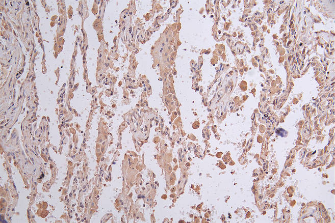 IHC image of the antibody diluted at 1:50 and staining in paraffin-embedded human lung cancer performed on a Leica BondTM system. After dewaxing and hydration, antigen retrieval was mediated by high pressure in a citrate buffer (pH 6.0). Section was blocked with 10% normal goat serum 30min at RT. Then primary antibody (1% BSA) was incubated at 4°C overnight. The primary is detected by a Goat anti-rabbit polymer IgG labeled by HRP and visualized using 0.26% DAB.