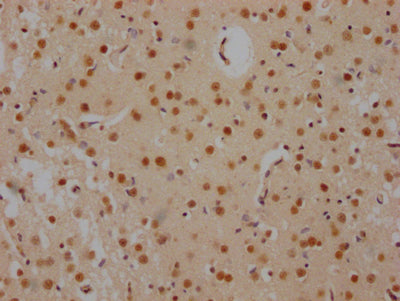 IHC image of FUBP1 Recombinant Monoclonal Antibody diluted at 1:100 and staining in paraffin-embedded human brain tissue performed on a Leica BondTM system. After dewaxing and hydration, antigen retrieval was mediated by high pressure in a citrate buffer (pH 6.0). Section was blocked with 10% normal goat serum 30min at RT. Then primary antibody (1% BSA) was incubated at 4℃ overnight. The primary is detected by a Goat anti-rabbit IgG polymer labeled by HRP and visualized using 0.05% DAB.FUBP1 Recombinant Monoclonal Antibody