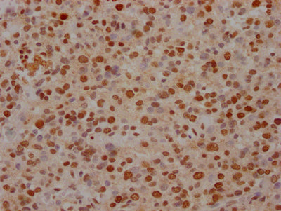 IHC image of FUBP1 Recombinant Monoclonal Antibody diluted at 1:100 and staining in paraffin-embedded human glioma cancer performed on a Leica BondTM system. After dewaxing and hydration, antigen retrieval was mediated by high pressure in a citrate buffer (pH 6.0). Section was blocked with 10% normal goat serum 30min at RT. Then primary antibody (1% BSA) was incubated at 4℃ overnight. The primary is detected by a Goat anti-rabbit IgG polymer labeled by HRP and visualized using 0.05% DAB.FUBP1 Recombinant Monoclonal Antibody