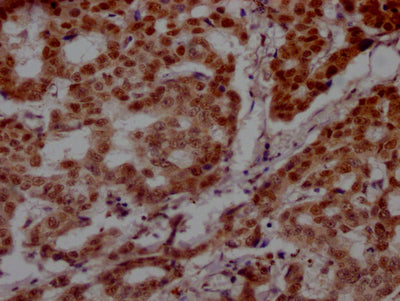 IHC image of PARP1 Recombinant Monoclonal Antibody diluted at 1:100 and staining in paraffin-embedded human breast cancer performed on a Leica BondTM system. After dewaxing and hydration, antigen retrieval was mediated by high pressure in a citrate buffer (pH 6.0). Section was blocked with 10% normal goat serum 30min at RT. Then primary antibody (1% BSA) was incubated at 4℃ overnight. The primary is detected by a Goat anti-rabbit IgG polymer labeled by HRP and visualized using 0.05% DAB.PARP1 Recombinant Monoclonal Antibody
