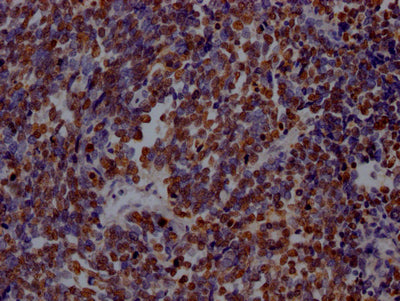 IHC image of PARP1 Recombinant Monoclonal Antibody diluted at 1:100 and staining in paraffin-embedded human lung cancer performed on a Leica BondTM system. After dewaxing and hydration, antigen retrieval was mediated by high pressure in a citrate buffer (pH 6.0). Section was blocked with 10% normal goat serum 30min at RT. Then primary antibody (1% BSA) was incubated at 4℃ overnight. The primary is detected by a Goat anti-rabbit IgG polymer labeled by HRP and visualized using 0.05% DAB.PARP1 Recombinant Monoclonal Antibody