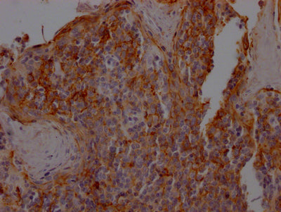 IHC image of the antibody diluted at 1:100 and staining in paraffin-embedded human tonsil tissue performed on a Leica BondTM system. After dewaxing and hydration, antigen retrieval was mediated by high pressure in a citrate buffer (pH 6.0). Section was blocked with 10% normal goat serum 30min at RT. Then primary antibody (1% BSA) was incubated at 4℃ overnight. The primary is detected by a Goat anti-rabbit IgG polymer labeled by HRP and visualized using 0.05% DAB.ICAM1 Recombinant Monoclonal Antibody
