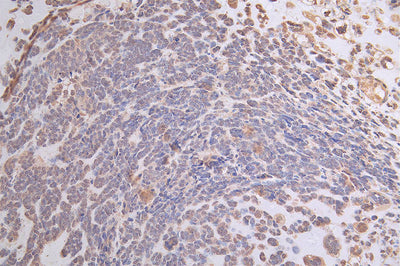 IHC image of ATP7B Recombinant Monoclonal Antibody diluted at 1:50 and staining in paraffin-embedded human ovarian cancer performed on a Leica BondTM system. After dewaxing and hydration, antigen retrieval was mediated by high pressure in a citrate buffer (pH 6.0). Section was blocked with 10% normal goat serum 30min at RT. Then primary antibody (1% BSA) was incubated at 4°C overnight. The primary is detected by a Goat anti-rabbit polymer IgG labeled by HRP and visualized using 0.19% DAB.ATP7B Recombinant Monoclonal Antibody