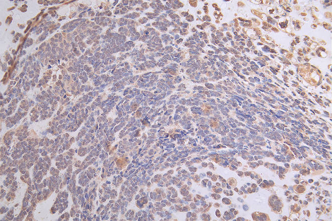 IHC image of ATP7B Recombinant Monoclonal Antibody diluted at 1:50 and staining in paraffin-embedded human ovarian cancer performed on a Leica BondTM system. After dewaxing and hydration, antigen retrieval was mediated by high pressure in a citrate buffer (pH 6.0). Section was blocked with 10% normal goat serum 30min at RT. Then primary antibody (1% BSA) was incubated at 4°C overnight. The primary is detected by a Goat anti-rabbit polymer IgG labeled by HRP and visualized using 0.19% DAB.ATP7B Recombinant Monoclonal Antibody