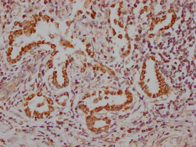 IHC image of NKX2-1 Recombinant Monoclonal Antibody diluted at 1:100 and staining in paraffin-embedded human lung tissue performed on a Leica BondTM system. After dewaxing and hydration, antigen retrieval was mediated by high pressure in a citrate buffer (pH 6.0). Section was blocked with 10% normal goat serum 30min at RT. Then primary antibody (1% BSA) was incubated at 4℃ overnight. The primary is detected by a Goat anti-rabbit IgG polymer labeled by HRP and visualized using 0.05% DAB.NKX2-1 Recombinant Monoclonal Antibody