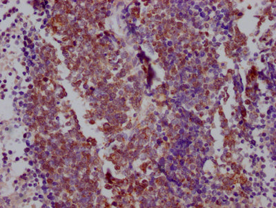 IHC image of NKX2-1 Recombinant Monoclonal Antibody diluted at 1:100 and staining in paraffin-embedded human lung cancer performed on a Leica BondTM system. After dewaxing and hydration, antigen retrieval was mediated by high pressure in a citrate buffer (pH 6.0). Section was blocked with 10% normal goat serum 30min at RT. Then primary antibody (1% BSA) was incubated at 4℃ overnight. The primary is detected by a Goat anti-rabbit IgG polymer labeled by HRP and visualized using 0.05% DAB.NKX2-1 Recombinant Monoclonal Antibody
