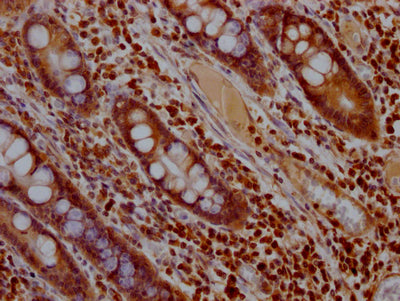 IHC image of MAPK1 Recombinant Monoclonal Antibody diluted at 1:100 and staining in paraffin-embedded human colon cancer performed on a Leica BondTM system. After dewaxing and hydration, antigen retrieval was mediated by high pressure in a citrate buffer (pH 6.0). Section was blocked with 10% normal goat serum 30min at RT. Then primary antibody (1% BSA) was incubated at 4℃ overnight. The primary is detected by a Goat anti-rabbit IgG polymer labeled by HRP and visualized using 0.05% DAB.MAPK1 Recombinant Monoclonal Antibody