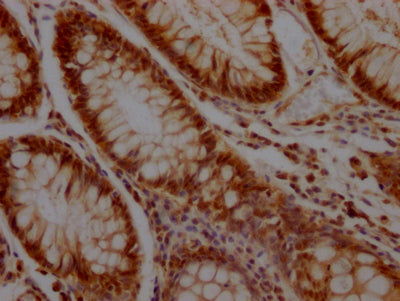 IHC image of KLF4 Recombinant Monoclonal Antibody diluted at 1:100 and staining in paraffin-embedded human colon cancer performed on a Leica BondTM system. After dewaxing and hydration, antigen retrieval was mediated by high pressure in a citrate buffer (pH 6.0). Section was blocked with 10% normal goat serum 30min at RT. Then primary antibody (1% BSA) was incubated at 4℃ overnight. The primary is detected by a Goat anti-rabbit IgG polymer labeled by HRP and visualized using 0.05% DAB.KLF4 Recombinant Monoclonal Antibody