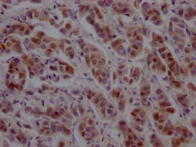 IHC image of GATA3 Recombinant Monoclonal Antibody diluted at 1:100 and staining in paraffin-embedded human breast cancer performed on a Leica BondTM system. After dewaxing and hydration, antigen retrieval was mediated by high pressure in a citrate buffer (pH 6.0). Section was blocked with 10% normal goat serum 30min at RT. Then primary antibody (1% BSA) was incubated at 4℃ overnight. The primary is detected by a Goat anti-rabbit IgG polymer labeled by HRP and visualized using 0.05% DAB.GATA3 Recombinant Monoclonal Antibody