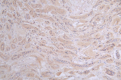 IHC image of the antibody diluted at 1:50 and staining in paraffin-embedded human kidney tissue performed on a Leica BondTM system. After dewaxing and hydration, antigen retrieval was mediated by high pressure in a citrate buffer (pH 6.0). Section was blocked with 10% normal goat serum 30min at RT. Then primary antibody (1% BSA) was incubated at 4°C overnight. The primary is detected by a Goat anti-rabbit polymer IgG labeled by HRP and visualized using 0.47% DAB.PRKAR2A Recombinant Monoclonal Antibody
