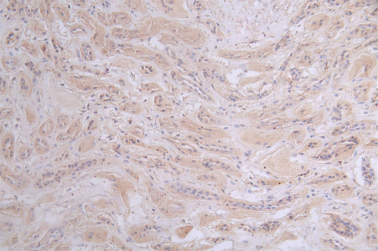 IHC image of the antibody diluted at 1:50 and staining in paraffin-embedded human kidney tissue performed on a Leica BondTM system. After dewaxing and hydration, antigen retrieval was mediated by high pressure in a citrate buffer (pH 6.0). Section was blocked with 10% normal goat serum 30min at RT. Then primary antibody (1% BSA) was incubated at 4°C overnight. The primary is detected by a Goat anti-rabbit polymer IgG labeled by HRP and visualized using 0.47% DAB.PRKAR2A Recombinant Monoclonal Antibody
