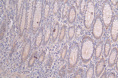 IHC image of PRKAR2A Recombinant Monoclonal Antibody diluted at 1:50 and staining in paraffin-embedded human rectal cancer performed on a Leica BondTM system. After dewaxing and hydration, antigen retrieval was mediated by high pressure in a citrate buffer (pH 6.0). Section was blocked with 10% normal goat serum 30min at RT. Then primary antibody (1% BSA) was incubated at 4°C overnight. The primary is detected by a Goat anti-rabbit polymer IgG labeled by HRP and visualized using 0.47% DAB.PRKAR2A Recombinant Monoclonal Antibody