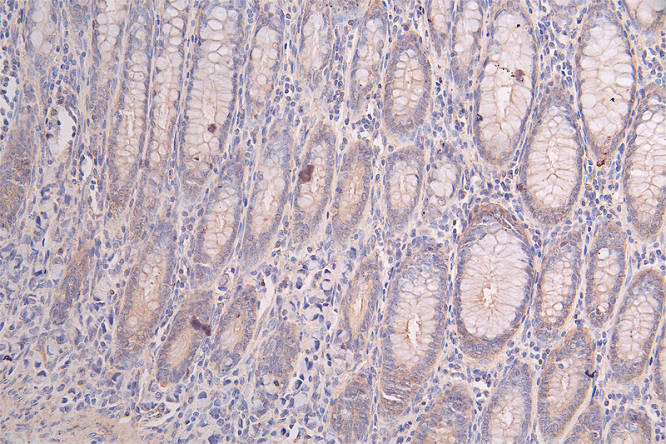 IHC image of PRKAR2A Recombinant Monoclonal Antibody diluted at 1:50 and staining in paraffin-embedded human rectal cancer performed on a Leica BondTM system. After dewaxing and hydration, antigen retrieval was mediated by high pressure in a citrate buffer (pH 6.0). Section was blocked with 10% normal goat serum 30min at RT. Then primary antibody (1% BSA) was incubated at 4°C overnight. The primary is detected by a Goat anti-rabbit polymer IgG labeled by HRP and visualized using 0.47% DAB.PRKAR2A Recombinant Monoclonal Antibody