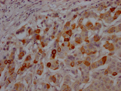 IHC image of GSK3B Recombinant Monoclonal Antibody diluted at 1:100 and staining in paraffin-embedded human breast cancer performed on a Leica BondTM system. After dewaxing and hydration, antigen retrieval was mediated by high pressure in a citrate buffer (pH 6.0). Section was blocked with 10% normal goat serum 30min at RT. Then primary antibody (1% BSA) was incubated at 4℃ overnight. The primary is detected by a Goat anti-rabbit IgG polymer labeled by HRP and visualized using 0.05% DAB.GSK3B Recombinant Monoclonal Antibody