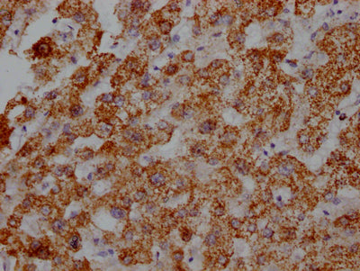 IHC image of ATP5B Recombinant Monoclonal Antibody diluted at 1:100 and staining in paraffin-embedded human liver tissue performed on a Leica BondTM system. After dewaxing and hydration, antigen retrieval was mediated by high pressure in a citrate buffer (pH 6.0). Section was blocked with 10% normal goat serum 30min at RT. Then primary antibody (1% BSA) was incubated at 4℃ overnight. The primary is detected by a Goat anti-rabbit IgG polymer labeled by HRP and visualized using 0.05% DAB.ATP5B Recombinant Monoclonal Antibody