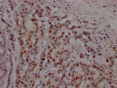 IHC image of AR Recombinant Monoclonal Antibody diluted at 1:100 and staining in paraffin-embedded human breast cancer performed on a Leica BondTM system. After dewaxing and hydration, antigen retrieval was mediated by high pressure in a citrate buffer (pH 6.0). Section was blocked with 10% normal goat serum 30min at RT. Then primary antibody (1% BSA) was incubated at 4℃ overnight. The primary is detected by a Goat anti-rabbit IgG polymer labeled by HRP and visualized using 0.05% DAB.AR Recombinant Monoclonal Antibody