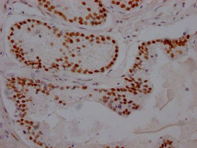 IHC image of AR Recombinant Monoclonal Antibody diluted at 1:100 and staining in paraffin-embedded human prostate cancer performed on a Leica BondTM system. After dewaxing and hydration, antigen retrieval was mediated by high pressure in a citrate buffer (pH 6.0). Section was blocked with 10% normal goat serum 30min at RT. Then primary antibody (1% BSA) was incubated at 4℃ overnight. The primary is detected by a Goat anti-rabbit IgG polymer labeled by HRP and visualized using 0.05% DAB.AR Recombinant Monoclonal Antibody