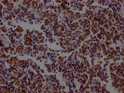IHC image of KDM1A Recombinant Monoclonal Antibody diluted at 1:100 and staining in paraffin-embedded human lung cancer performed on a Leica BondTM system. After dewaxing and hydration, antigen retrieval was mediated by high pressure in a citrate buffer (pH 6.0). Section was blocked with 10% normal goat serum 30min at RT. Then primary antibody (1% BSA) was incubated at 4℃ overnight. The primary is detected by a Goat anti-rabbit IgG polymer labeled by HRP and visualized using 0.05% DAB.KDM1A Recombinant Monoclonal Antibody