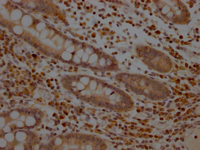 IHC image of MAP2K1 Recombinant Monoclonal Antibody diluted at 1:100 and staining in paraffin-embedded human colon cancer performed on a Leica BondTM system. After dewaxing and hydration, antigen retrieval was mediated by high pressure in a citrate buffer (pH 6.0). Section was blocked with 10% normal goat serum 30min at RT. Then primary antibody (1% BSA) was incubated at 4℃ overnight. The primary is detected by a Goat anti-rabbit IgG polymer labeled by HRP and visualized using 0.05% DAB.MAP2K1 Recombinant Monoclonal Antibody