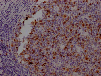 IHC image of AURKB Recombinant Monoclonal Antibody diluted at 1:100 and staining in paraffin-embedded human tonsil tissue performed on a Leica BondTM system. After dewaxing and hydration, antigen retrieval was mediated by high pressure in a citrate buffer (pH 6.0). Section was blocked with 10% normal goat serum 30min at RT. Then primary antibody (1% BSA) was incubated at 4℃ overnight. The primary is detected by a Goat anti-rabbit IgG polymer labeled by HRP and visualized using 0.05% DAB.AURKB Recombinant Monoclonal Antibody