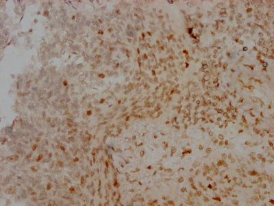 IHC image of AURKB Recombinant Monoclonal Antibody diluted at 1:100 and staining in paraffin-embedded human cervical cancer performed on a Leica BondTM system. After dewaxing and hydration, antigen retrieval was mediated by high pressure in a citrate buffer (pH 6.0). Section was blocked with 10% normal goat serum 30min at RT. Then primary antibody (1% BSA) was incubated at 4℃ overnight. The primary is detected by a Goat anti-rabbit IgG polymer labeled by HRP and visualized using 0.05% DAB.AURKB Recombinant Monoclonal Antibody