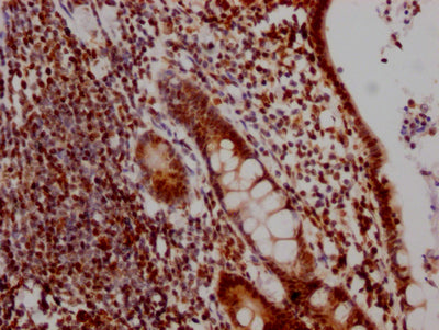 IHC image of DDX5 Recombinant Monoclonal Antibody diluted at 1:100 and staining in paraffin-embedded human colon cancer performed on a Leica BondTM system. After dewaxing and hydration, antigen retrieval was mediated by high pressure in a citrate buffer (pH 6.0). Section was blocked with 10% normal goat serum 30min at RT. Then primary antibody (1% BSA) was incubated at 4℃ overnight. The primary is detected by a Goat anti-rabbit IgG polymer labeled by HRP and visualized using 0.05% DAB.