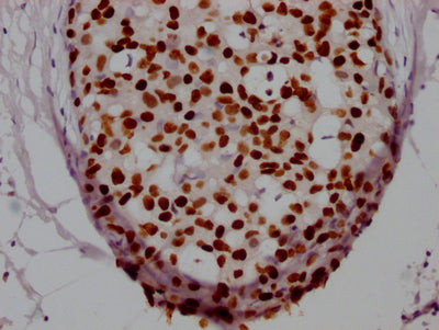 IHC image of FOXA1 Recombinant Monoclonal Antibody diluted at 1:100 and staining in paraffin-embedded human breast cancer performed on a Leica BondTM system. After dewaxing and hydration, antigen retrieval was mediated by high pressure in a citrate buffer (pH 6.0). Section was blocked with 10% normal goat serum 30min at RT. Then primary antibody (1% BSA) was incubated at 4℃ overnight. The primary is detected by a Goat anti-rabbit IgG polymer labeled by HRP and visualized using 0.05% DAB.FOXA1 Recombinant Monoclonal Antibody