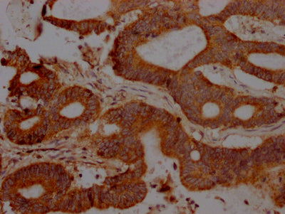 IHC image of FAS Recombinant Monoclonal Antibody diluted at 1:100 and staining in paraffin-embedded human colon cancer performed on a Leica BondTM system. After dewaxing and hydration, antigen retrieval was mediated by high pressure in a citrate buffer (pH 6.0). Section was blocked with 10% normal goat serum 30min at RT. Then primary antibody (1% BSA) was incubated at 4℃ overnight. The primary is detected by a Goat anti-rabbit IgG polymer labeled by HRP and visualized using 0.05% DAB.