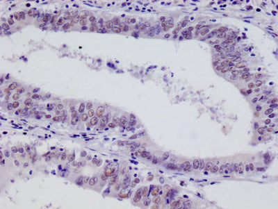 IHC image of HIF1AN Recombinant Monoclonal Antibody diluted at 1:100 and staining in paraffin-embedded human colon cancer performed on a Leica BondTM system. After dewaxing and hydration, antigen retrieval was mediated by high pressure in a citrate buffer (pH 6.0). Section was blocked with 10% normal goat serum 30min at RT. Then primary antibody (1% BSA) was incubated at 4°C overnight. The primary is detected by a Goat anti-rabbit polymer IgG labeled by HRP and visualized using 0.05% DAB.HIF1AN Recombinant Monoclonal Antibody
