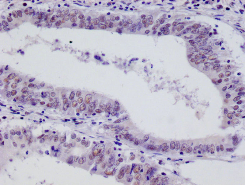 IHC image of HIF1AN Recombinant Monoclonal Antibody diluted at 1:100 and staining in paraffin-embedded human colon cancer performed on a Leica BondTM system. After dewaxing and hydration, antigen retrieval was mediated by high pressure in a citrate buffer (pH 6.0). Section was blocked with 10% normal goat serum 30min at RT. Then primary antibody (1% BSA) was incubated at 4°C overnight. The primary is detected by a Goat anti-rabbit polymer IgG labeled by HRP and visualized using 0.05% DAB.HIF1AN Recombinant Monoclonal Antibody