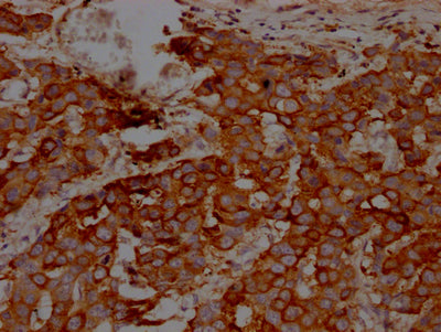 IHC image of IKBKB Recombinant Monoclonal Antibody diluted at 1:100 and staining in paraffin-embedded human breast cancer performed on a Leica BondTM system. After dewaxing and hydration, antigen retrieval was mediated by high pressure in a citrate buffer (pH 6.0). Section was blocked with 10% normal goat serum 30min at RT. Then primary antibody (1% BSA) was incubated at 4℃ overnight. The primary is detected by a Goat anti-rabbit IgG polymer labeled by HRP and visualized using 0.05% DAB.IKBKB Recombinant Monoclonal Antibody