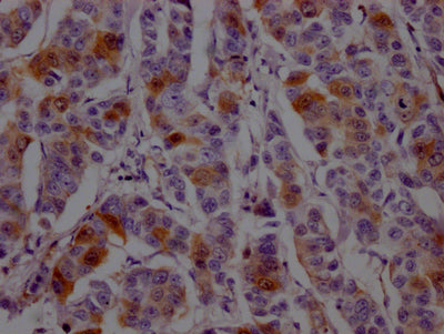IHC image of DHFR Recombinant Monoclonal Antibody diluted at 1:100 and staining in paraffin-embedded human breast cancer performed on a Leica BondTM system. After dewaxing and hydration, antigen retrieval was mediated by high pressure in a citrate buffer (pH 6.0). Section was blocked with 10% normal goat serum 30min at RT. Then primary antibody (1% BSA) was incubated at 4℃ overnight. The primary is detected by a Goat anti-rabbit IgG polymer labeled by HRP and visualized using 0.05% DAB.