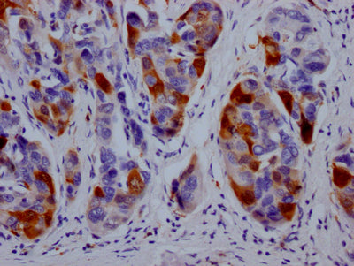 IHC image of DHFR Recombinant Monoclonal Antibody diluted at 1:100 and staining in paraffin-embedded human liver cancer performed on a Leica BondTM system. After dewaxing and hydration, antigen retrieval was mediated by high pressure in a citrate buffer (pH 6.0). Section was blocked with 10% normal goat serum 30min at RT. Then primary antibody (1% BSA) was incubated at 4℃ overnight. The primary is detected by a Goat anti-rabbit IgG polymer labeled by HRP and visualized using 0.05% DAB.