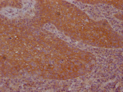 IHC image of FNTB Recombinant Monoclonal Antibody diluted at 1:100 and staining in paraffin-embedded human tonsil tissue performed on a Leica BondTM system. After dewaxing and hydration, antigen retrieval was mediated by high pressure in a citrate buffer (pH 6.0). Section was blocked with 10% normal goat serum 30min at RT. Then primary antibody (1% BSA) was incubated at 4℃ overnight. The primary is detected by a Goat anti-rabbit IgG polymer labeled by HRP and visualized using 0.05% DAB.FNTB Recombinant Monoclonal Antibody
