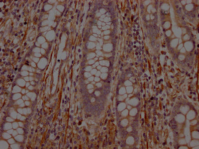 IHC image of PTPN1 Recombinant Monoclonal Antibody diluted at 1:100 and staining in paraffin-embedded human colon cancer performed on a Leica BondTM system. After dewaxing and hydration, antigen retrieval was mediated by high pressure in a citrate buffer (pH 6.0). Section was blocked with 10% normal goat serum 30min at RT. Then primary antibody (1% BSA) was incubated at 4℃ overnight. The primary is detected by a Goat anti-rabbit IgG polymer labeled by HRP and visualized using 0.05% DAB.PTPN1 Recombinant Monoclonal Antibody