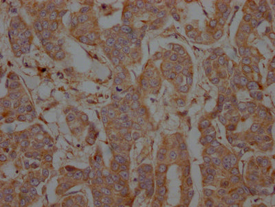 IHC image of PTPN1 Recombinant Monoclonal Antibody diluted at 1:100 and staining in paraffin-embedded human breast cancer performed on a Leica BondTM system. After dewaxing and hydration, antigen retrieval was mediated by high pressure in a citrate buffer (pH 6.0). Section was blocked with 10% normal goat serum 30min at RT. Then primary antibody (1% BSA) was incubated at 4℃ overnight. The primary is detected by a Goat anti-rabbit IgG polymer labeled by HRP and visualized using 0.05% DAB.PTPN1 Recombinant Monoclonal Antibody