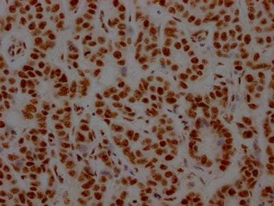IHC image of NONO Recombinant Monoclonal Antibody diluted at 1:100 and staining in paraffin-embedded human breast cancer performed on a Leica BondTM system. After dewaxing and hydration, antigen retrieval was mediated by high pressure in a citrate buffer (pH 6.0). Section was blocked with 10% normal goat serum 30min at RT. Then primary antibody (1% BSA) was incubated at 4℃ overnight. The primary is detected by a Goat anti-rabbit IgG polymer labeled by HRP and visualized using 0.05% DAB.NONO Recombinant Monoclonal Antibody