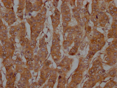 IHC image of CASP3 Recombinant Monoclonal Antibody diluted at 1:100 and staining in paraffin-embedded human breast cancer performed on a Leica BondTM system. After dewaxing and hydration, antigen retrieval was mediated by high pressure in a citrate buffer (pH 6.0). Section was blocked with 10% normal goat serum 30min at RT. Then primary antibody (1% BSA) was incubated at 4℃ overnight. The primary is detected by a Goat anti-rabbit IgG polymer labeled by HRP and visualized using 0.05% DAB.