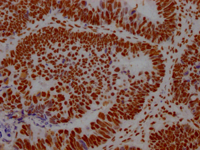 IHC image of the antibody diluted at 1:100 and staining in paraffin-embedded human ovarian cancer performed on a Leica BondTM system. After dewaxing and hydration, antigen retrieval was mediated by high pressure in a citrate buffer (pH 6.0). Section was blocked with 10% normal goat serum 30min at RT. Then primary antibody (1% BSA) was incubated at 4℃ overnight. The primary is detected by a Goat anti-rabbit IgG polymer labeled by HRP and visualized using 0.05% DAB.ILF3 Recombinant Monoclonal Antibody