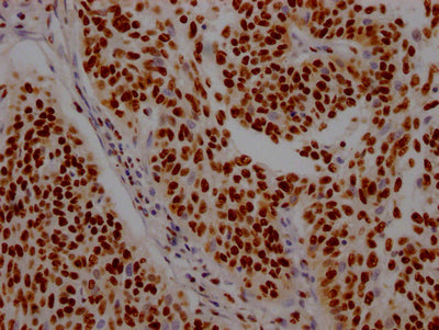 IHC image of ILF3 Recombinant Monoclonal Antibody diluted at 1:100 and staining in paraffin-embedded human cervical cancer performed on a Leica BondTM system. After dewaxing and hydration, antigen retrieval was mediated by high pressure in a citrate buffer (pH 6.0). Section was blocked with 10% normal goat serum 30min at RT. Then primary antibody (1% BSA) was incubated at 4℃ overnight. The primary is detected by a Goat anti-rabbit IgG polymer labeled by HRP and visualized using 0.05% DAB.ILF3 Recombinant Monoclonal Antibody