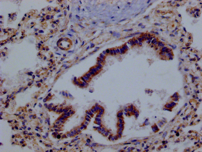 IHC image of PRDX3 Recombinant Monoclonal Antibody diluted at 1:100 and staining in paraffin-embedded human lung tissue performed on a Leica BondTM system. After dewaxing and hydration, antigen retrieval was mediated by high pressure in a citrate buffer (pH 6.0). Section was blocked with 10% normal goat serum 30min at RT. Then primary antibody (1% BSA) was incubated at 4°C overnight. The primary is detected by a Goat anti-rabbit polymer IgG labeled by HRP and visualized using 0.05% DAB.PRDX3 Recombinant Monoclonal Antibody